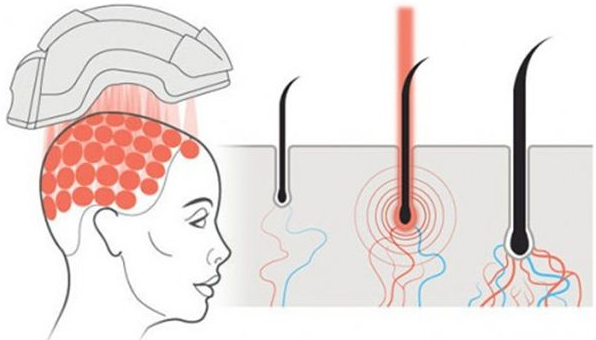 激光生发激光管